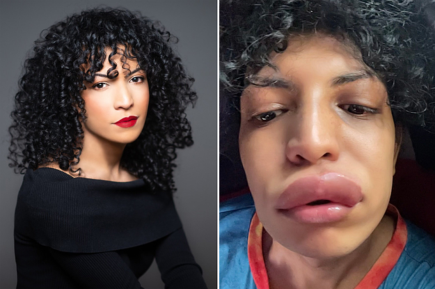 This Woman’s “Kiss Of Death” Shows Just How Serious Allergic Reactions Can Be
